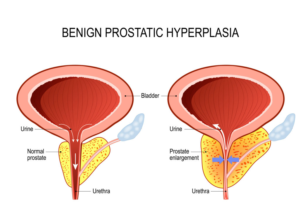Symptoms of Enlarged Prostate Disease (BPH) Alpha Rise Health