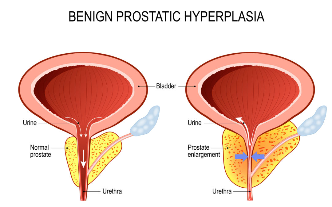 Prostate BPH diagram