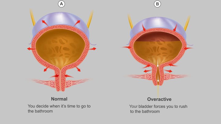 Kegel és prostatitis gyakorlása